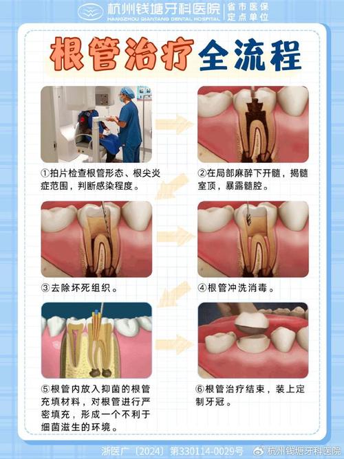 根管预备有哪些方法?如何确保预备效果与安全?-图3 根管预备有哪些方法?如何确保预备效果与安全?-图3