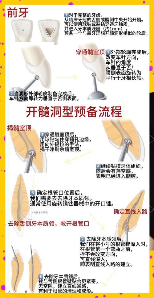 根管预备有哪些方法？如何确保预备效果与安全？-图2