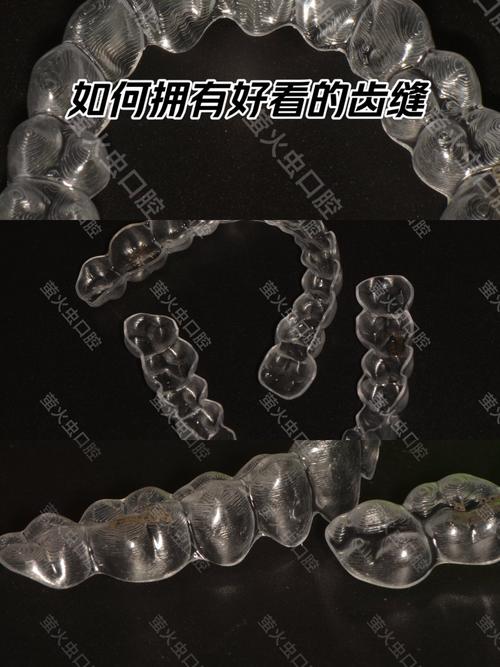 小孩正畸保持器有哪几种类型？如何正确选择和使用？-图3