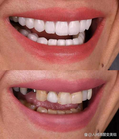 磨牙烤瓷牙能否进行正畸治疗？-图3