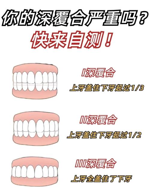 深覆合矫正有哪些方法?哪种更安全有效?-图1 深覆合矫正有哪些方法?哪种更安全有效?-图1