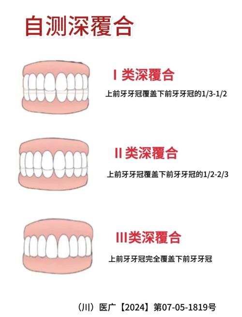 深覆合矫正有哪些方法？哪种更安全有效？-图2
