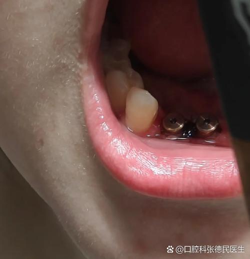 种牙后肿胀一般持续多少天？-图3