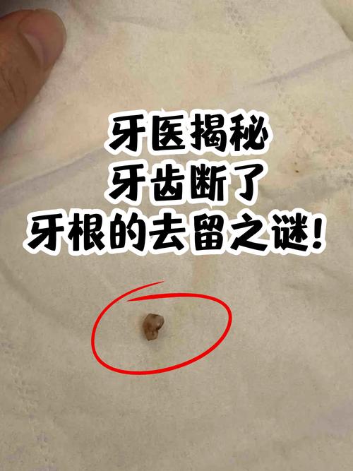 牙根断了必须种牙吗?还有其他修复选择吗?-图1 牙根断了必须种牙吗?还有其他修复选择吗?-图1