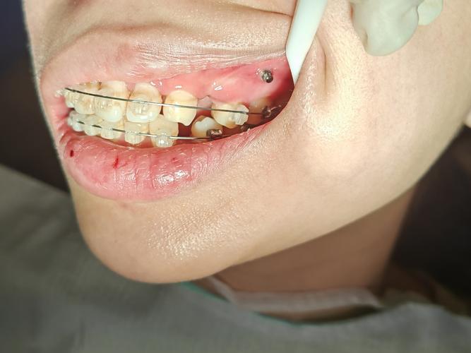 正畸牙齿后为何不能吃东西?饮食限制何时能解除?-图3 正畸牙齿后为何不能吃东西?饮食限制何时能解除?-图3