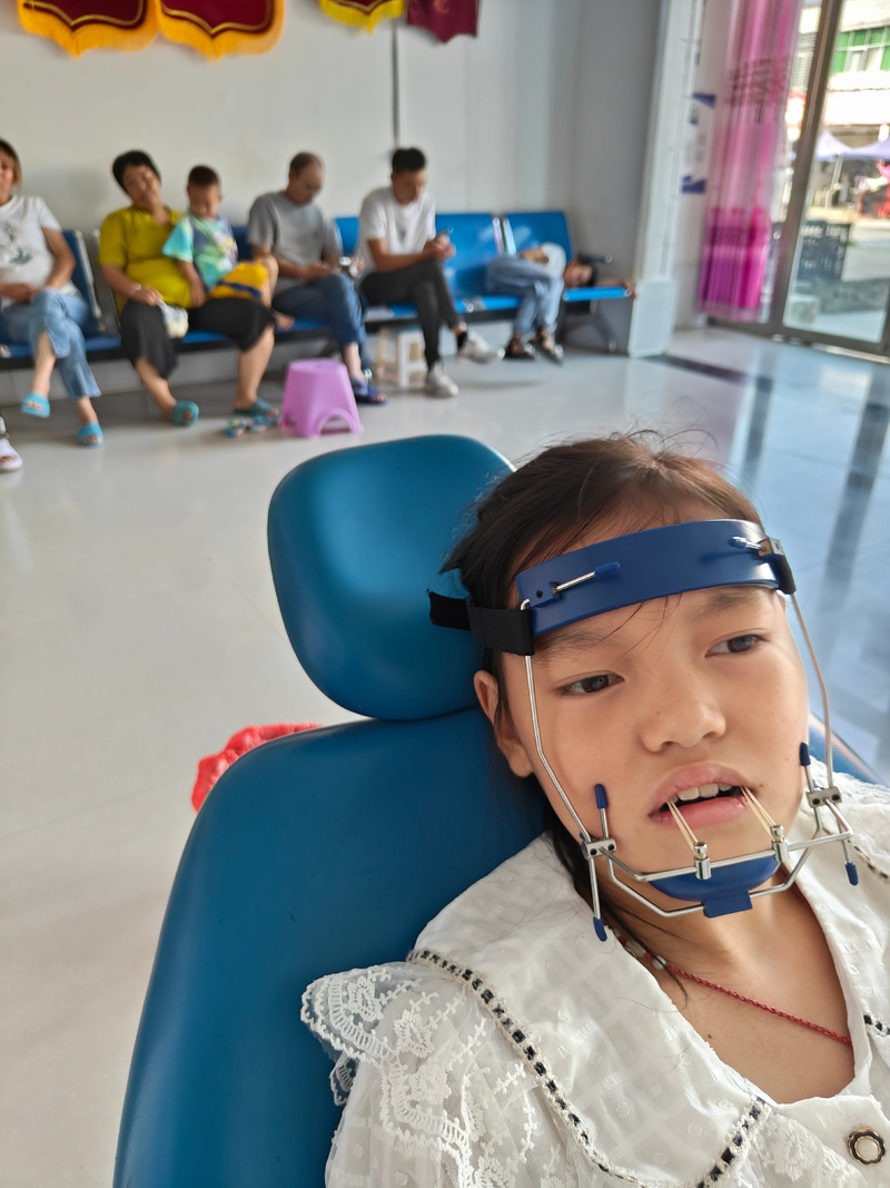 儿童反颌有哪些好的治疗方法?-图2 儿童反颌有哪些好的治疗方法?-图2