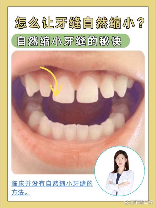 正畸磨牙关缝的方法有哪些?不同方法的效果与注意事项是什么?-图3 正畸磨牙关缝的方法有哪些?不同方法的效果与注意事项是什么?-图3