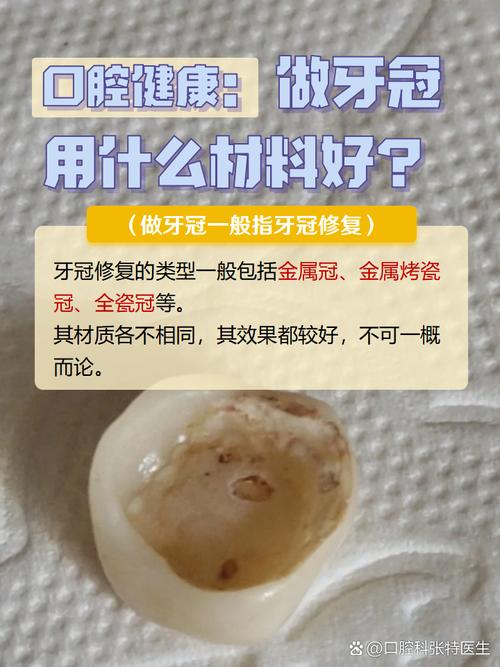 种牙后牙冠制作要多久?一般需要多长时间?-图2 种牙后牙冠制作要多久?一般需要多长时间?-图2