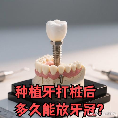 种牙后牙冠制作要多久?一般需要多长时间?-图1 种牙后牙冠制作要多久?一般需要多长时间?-图1