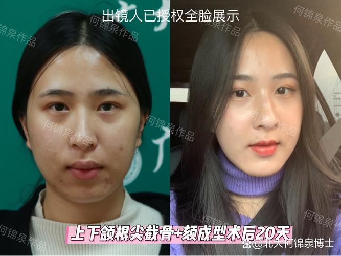 正畸什么脸型改变大?龅牙还是地包天效果显著?-图3 正畸什么脸型改变大?龅牙还是地包天效果显著?-图3