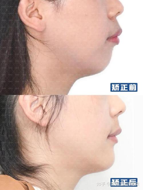 正畸什么脸型改变大?龅牙还是地包天效果显著?-图1 正畸什么脸型改变大?龅牙还是地包天效果显著?-图1