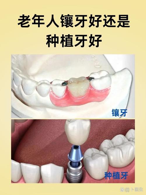 70多岁还能种牙吗？高龄种牙有哪些要注意的？-图2