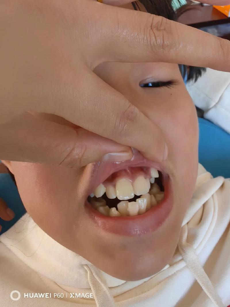 带牙套正畸期间能怀孕吗？会有影响吗？-图1