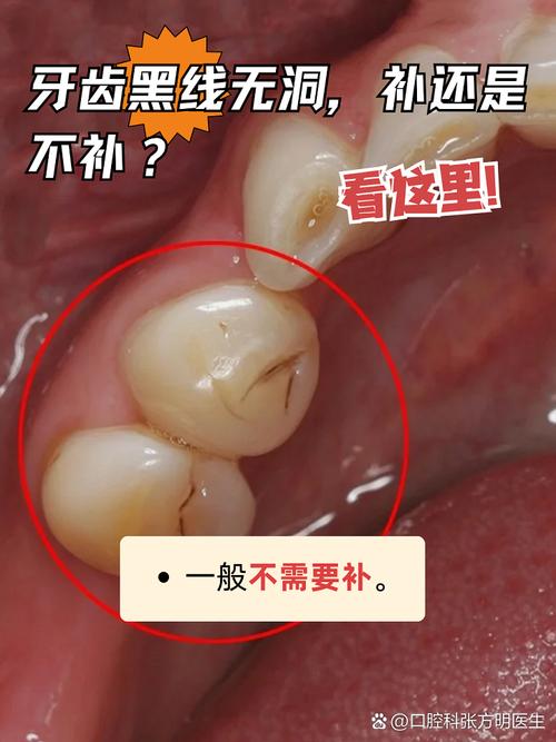 正畸后最后一颗牙窝沟龋，为何发生对口腔有何影响又该如何有效解决？-图3