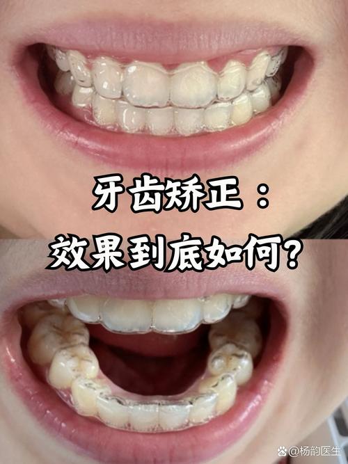 矫正与种植,哪种方案更适合你的牙齿需求?-图1 矫正与种植,哪种方案更适合你的牙齿需求?-图1