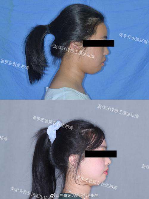 牙齿不齐却无法正畸，究竟是什么原因？-图1