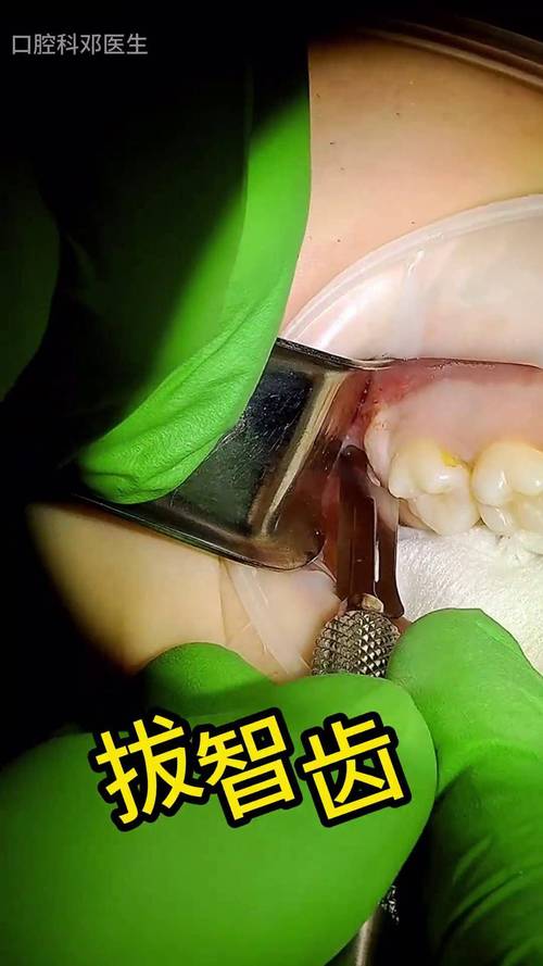 微创拔智齿的正确方法具体该怎么操作？-图2
