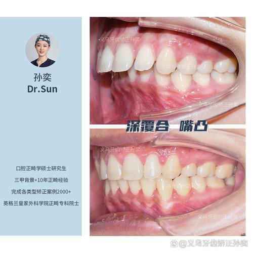 口腔颌面外科能正畸吗？-图1