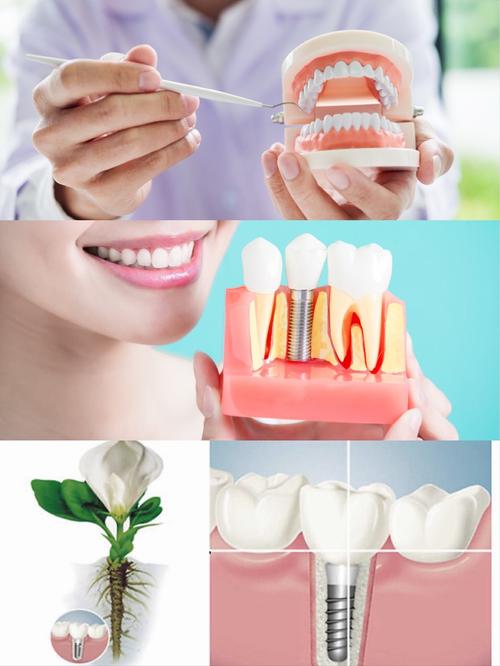 深圳镶牙补牙种牙服务该怎么选？哪种方式更适合自己呢？-图2