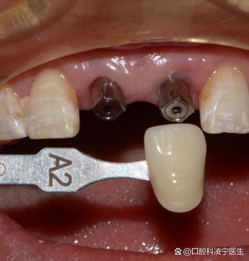 深圳镶牙补牙种牙服务该怎么选？哪种方式更适合自己呢？-图3