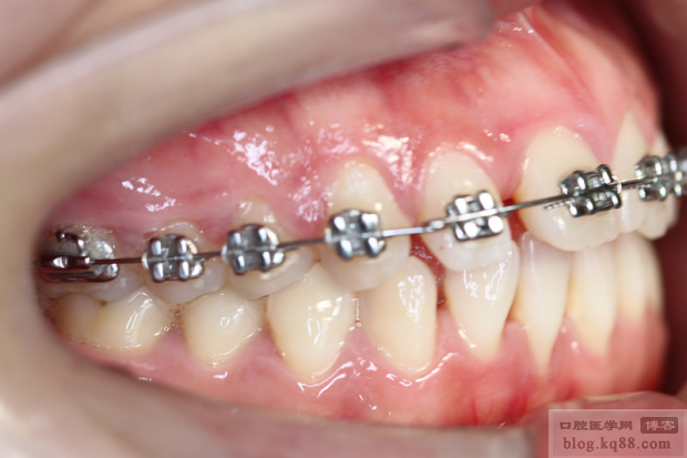 牙周加速成骨正畸治疗的效果与优势是什么?-图2 牙周加速成骨正畸治疗的效果与优势是什么?-图2