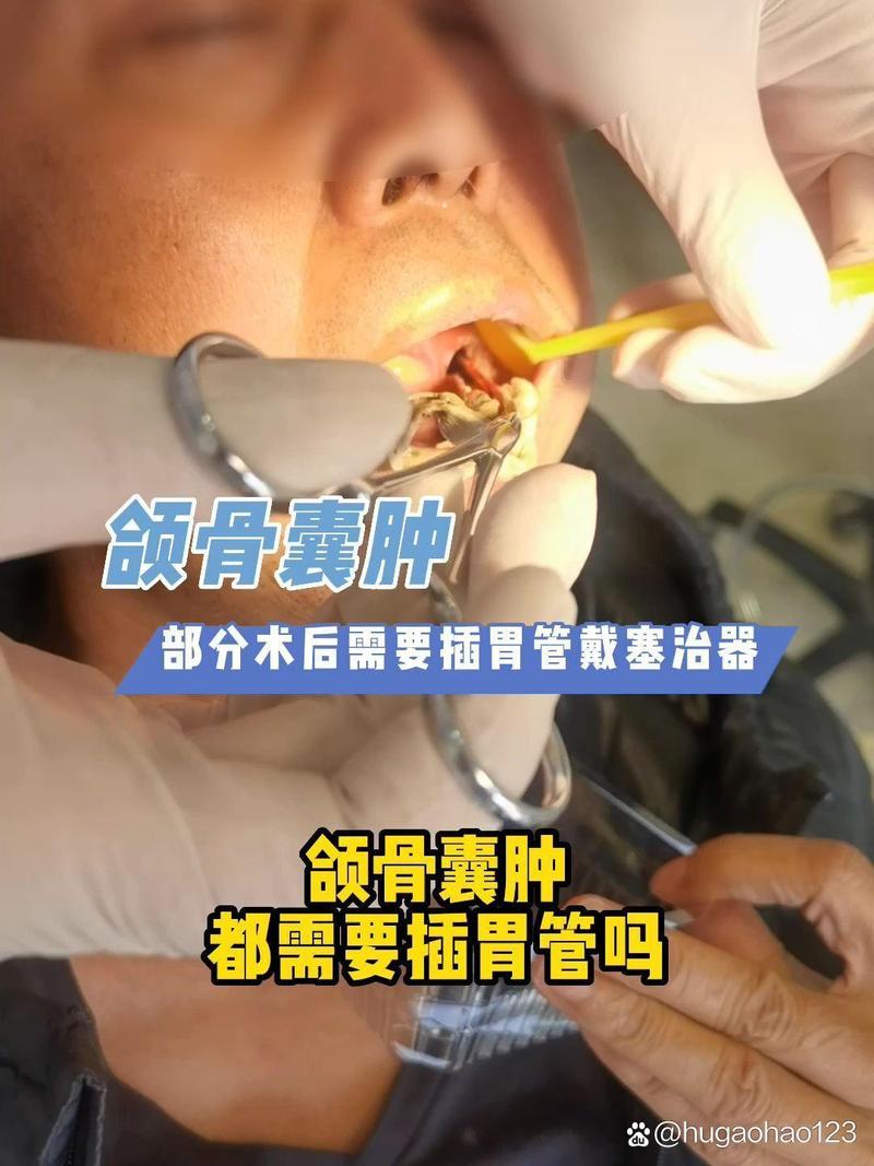 下颌骨囊肿冲洗如何规范操作？关键步骤与注意事项有哪些？-图3