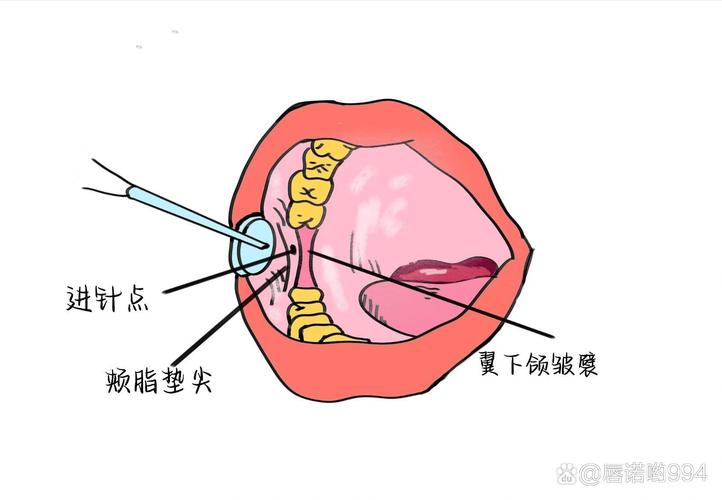 种牙手术为何采用局部麻醉?其具体类型和适用情况是怎样的?-图3 种牙手术为何采用局部麻醉?其具体类型和适用情况是怎样的?-图3