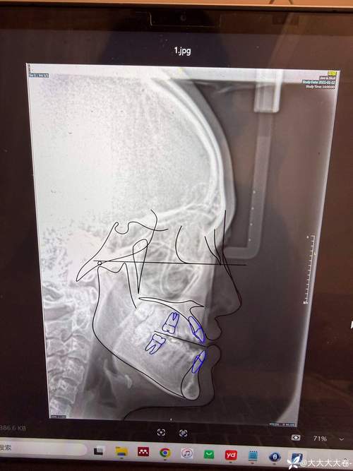 正畸头影测量分析报告的关键指标如何解读以指导正畸方案制定？-图2