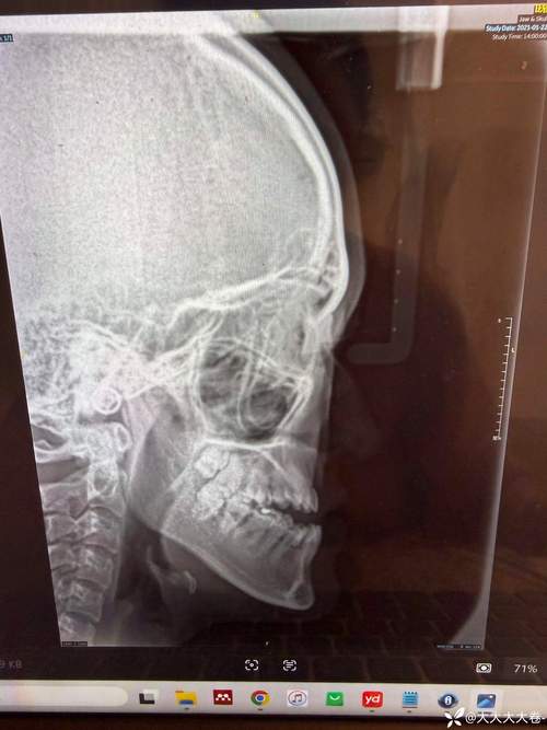 正畸头影测量分析报告的关键指标如何解读以指导正畸方案制定?-图3 正畸头影测量分析报告的关键指标如何解读以指导正畸方案制定?-图3