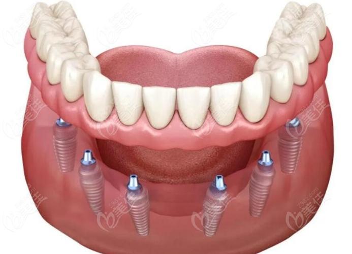 东莞虎门那里种牙好-图3 东莞虎门那里种牙好-图3