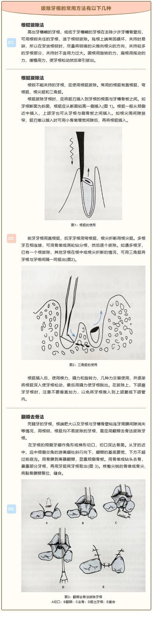 下颌磨牙的拔除方法-图1