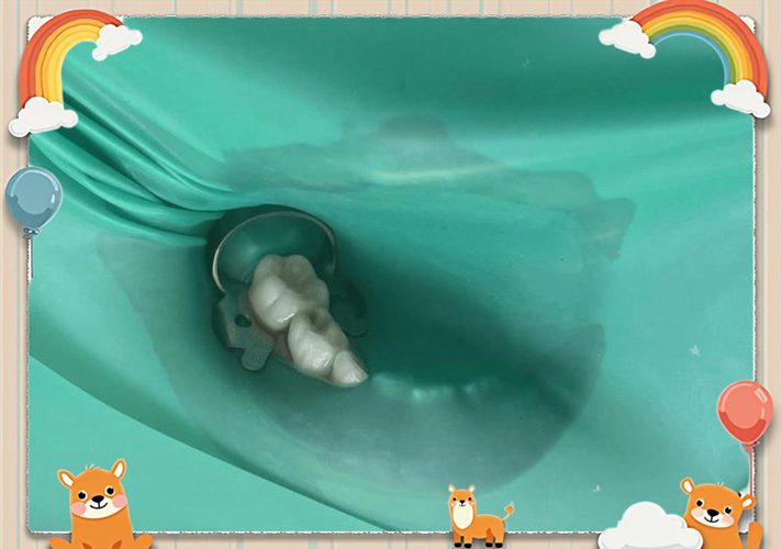 橡皮障拍片的方法有哪些关键操作步骤?-图2 橡皮障拍片的方法有哪些关键操作步骤?-图2