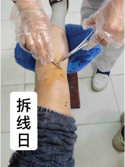 种牙术后拆线前能运动吗?这些注意事项要知晓-图2 种牙术后拆线前能运动吗?这些注意事项要知晓-图2