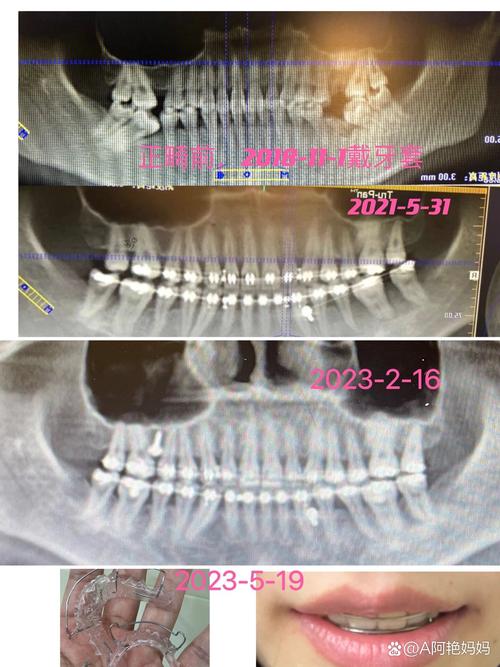 广东省口腔正畸科费用多少?不同医院差异原因是什么?-图3 广东省口腔正畸科费用多少?不同医院差异原因是什么?-图3