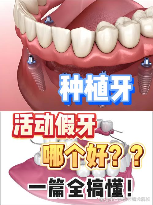 镶牙和种牙哪个更好？哪种更适合你的牙齿需求？-图2