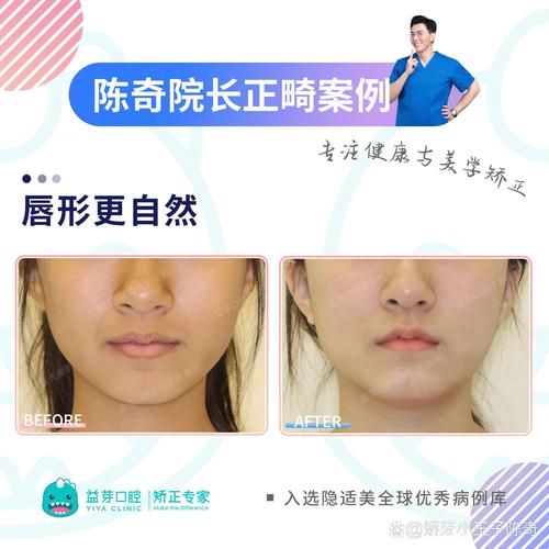 做完美容冠后还能进行牙齿正畸吗？-图3