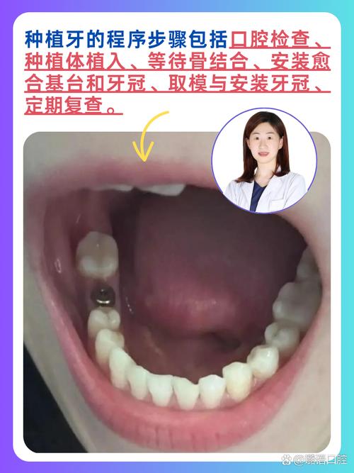 牙距4cm能种牙吗？需要满足哪些条件？-图3