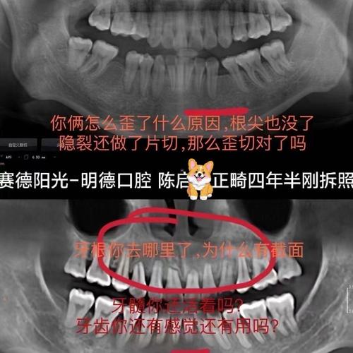正畸后牙槽吸收X光能发现什么问题？-图2