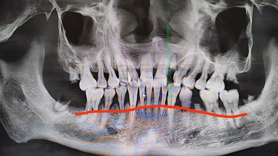 正畸后牙槽吸收X光能发现什么问题?-图1 正畸后牙槽吸收X光能发现什么问题?-图1