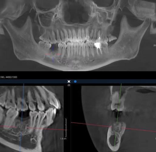 根管治疗后牙齿正畸可行?效果及注意事项如何-图2 根管治疗后牙齿正畸可行?效果及注意事项如何-图2