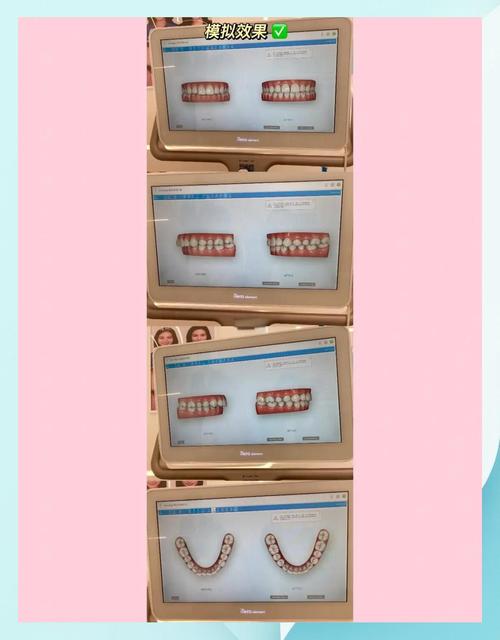 口内扫描仪在正畸中具体有哪些关键作用?-图1 口内扫描仪在正畸中具体有哪些关键作用?-图1