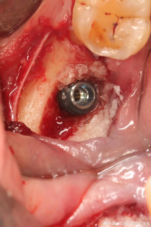 植骨后牙颌骨能种牙吗？需要多久能种？成功率如何？-图2