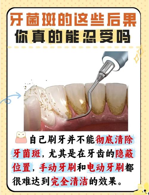 去牙菌斑最有效方法是什么?科学指南帮你找答案!-图3 去牙菌斑最有效方法是什么?科学指南帮你找答案!-图3