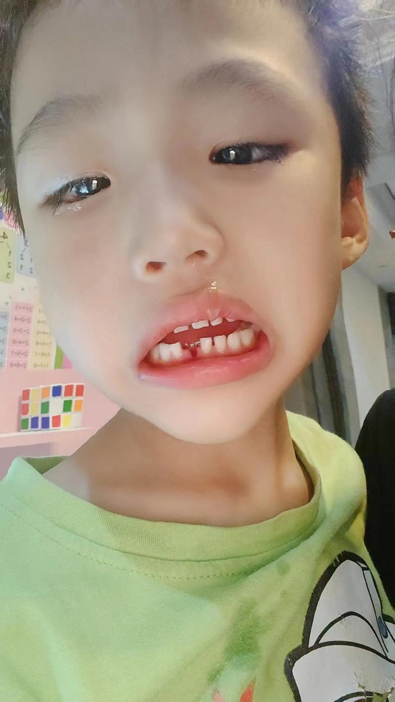 一颗牙没有可种牙吗-图1 一颗牙没有可种牙吗-图1