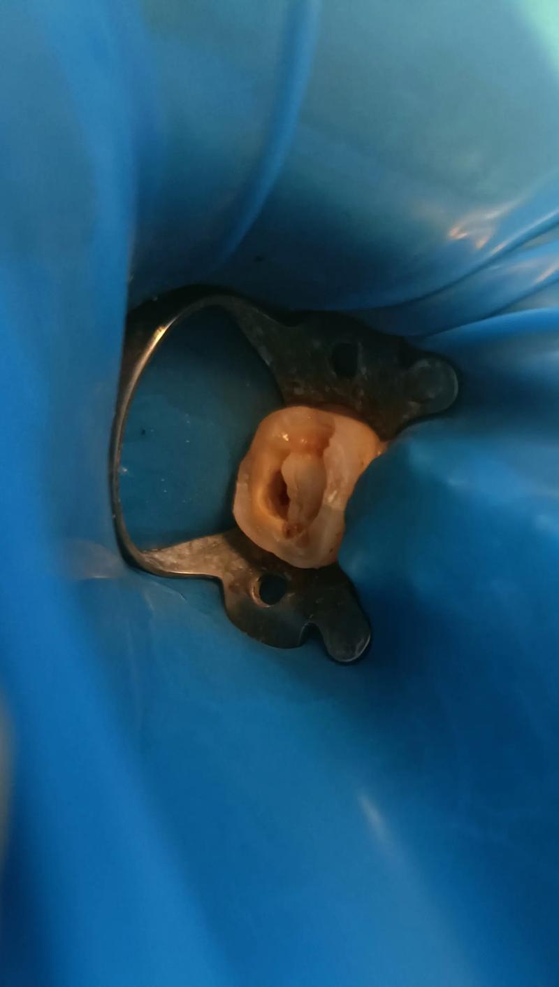 一颗牙没有可种牙吗-图3 一颗牙没有可种牙吗-图3