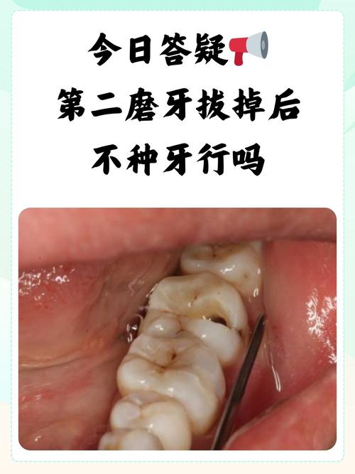 拔牙2年后能种牙吗?-图2 拔牙2年后能种牙吗?-图2