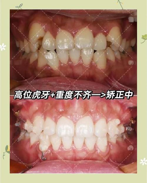 杭州虎牙矫正有哪些方法？如何选择适合自己的矫正方式？-图3