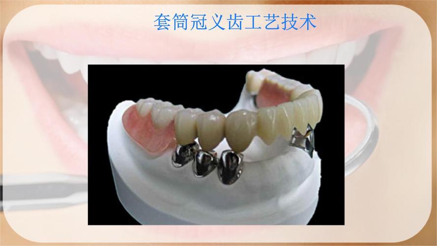 义齿变形的处理方法-图2 义齿变形的处理方法-图2