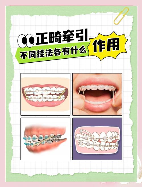 正畸橡皮链怎么安装?详细方法与操作技巧全解析-图1 正畸橡皮链怎么安装?详细方法与操作技巧全解析-图1