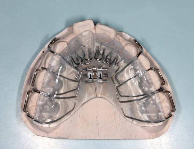 肌功能矫治器正畸图片能直观展示哪些不同矫正作用、效果及适用人群?-图1 肌功能矫治器正畸图片能直观展示哪些不同矫正作用、效果及适用人群?-图1